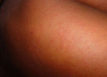 measles gauteng outbreak