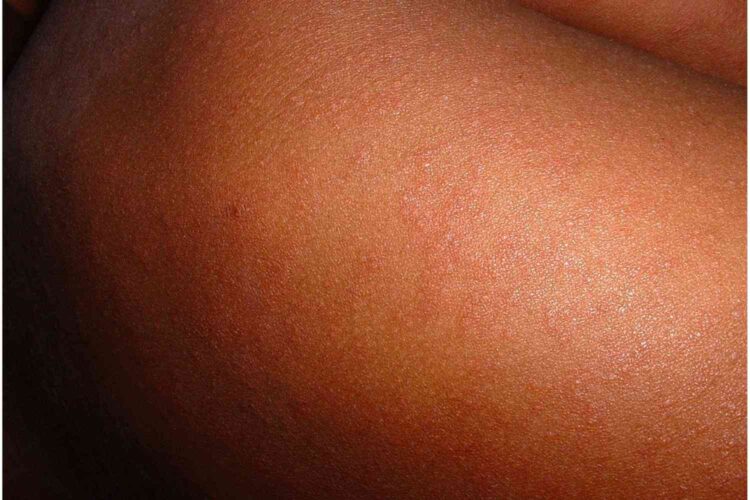 measles gauteng outbreak