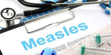 measles outbreak limpopo